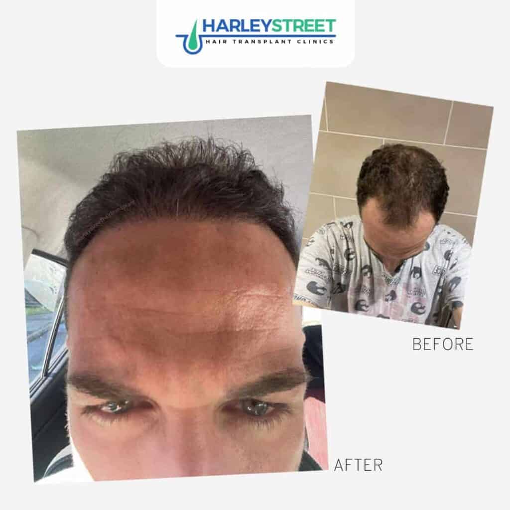 Harley-Street-Hair-Transplant-Clinics-Patient-with-hairline-recession-before-and-after