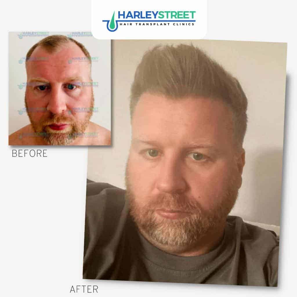 Harley-Street-Hair-Transplant-Clinics-patient-Aaron-before-and-after-1